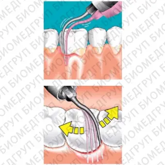 Sonicflex paro 62  насадка с рабочим концом, изогнутым вправо с закругленной верхушкой для минимально инвазивной терапии пародонтита