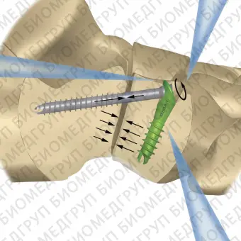 Артродезный винт плюснефаланговый сустав IO Fix
