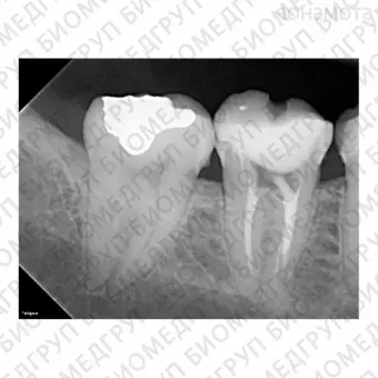 SOPIX2  система компьютерной визиографии стоматологический визиограф