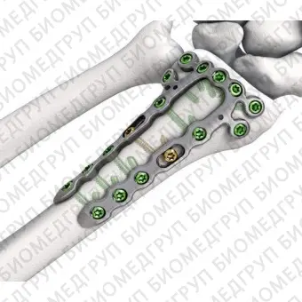Компрессионная костная пластина лучевая кость LOQTEQ VA 2.5