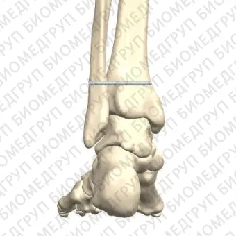 Компрессионная костная пластина малоберцовая кость FreedomPlate