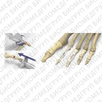 Компрессирующий винт для кости артродез межфалангового сустава ноги PHALINX