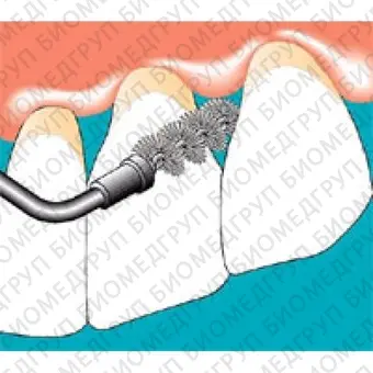 Sonicflex clean  набор насадок и щетки Sono для профессиональной механической чистки зубов снятия зубных отложений